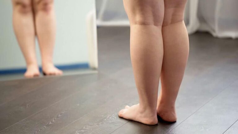 Qué es el lipedema y cómo se trata este problema que afecta a las mujeres?